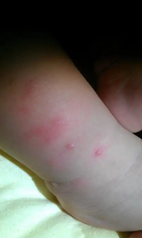 八个月宝宝腿上起红疙瘩之后变成小水泡