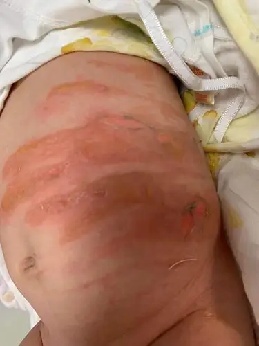 广安东方童话儿童摄影烫伤婴儿