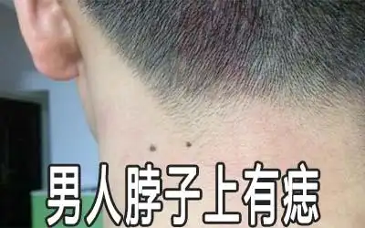 男人脖子上有痣痣相解析