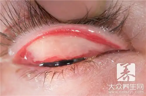 结膜炎的症状有眼部异物感,烧灼,瘙痒,畏光,流泪等.