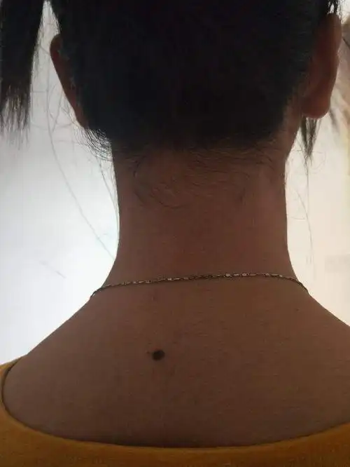 痣相算命:背部有痣好不好