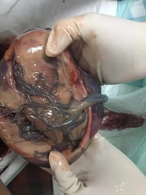 每日一图:这个胎盘究竟是怎么回事?谁能给个答案 [病例帖]