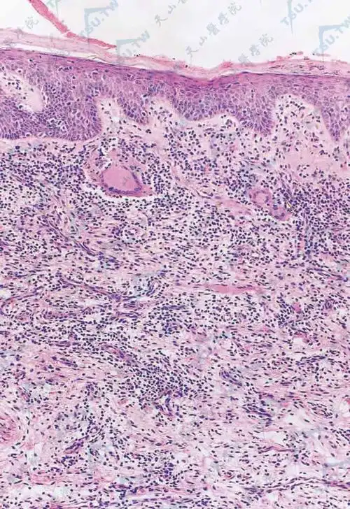 肉芽肿性皮肤松弛症