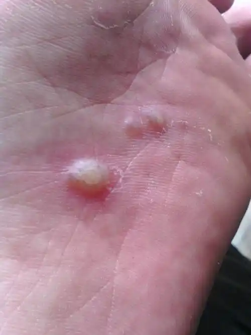 脚上起泡,这是怎么了?