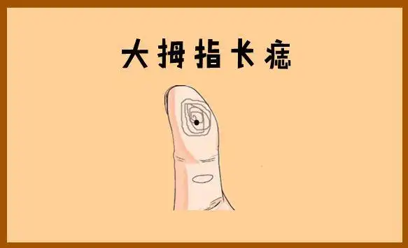 大拇指长痣在相学中,若是在大拇指的位置处长有吉痣,则他们的进财比较