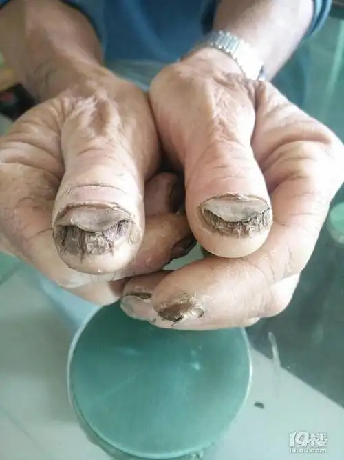 可怜的老人可怕的灰指甲求名医