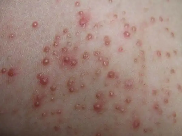 背部毛囊炎怎么治疗好