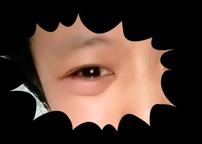 今天早上起来右眼下眼袋突然肿了,还有点疼,感觉不想睁眼,睡前没喝水