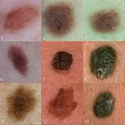 首选!盘点黑色素瘤早期症状"捧腹大笑"-第1张图片-伊卡博客