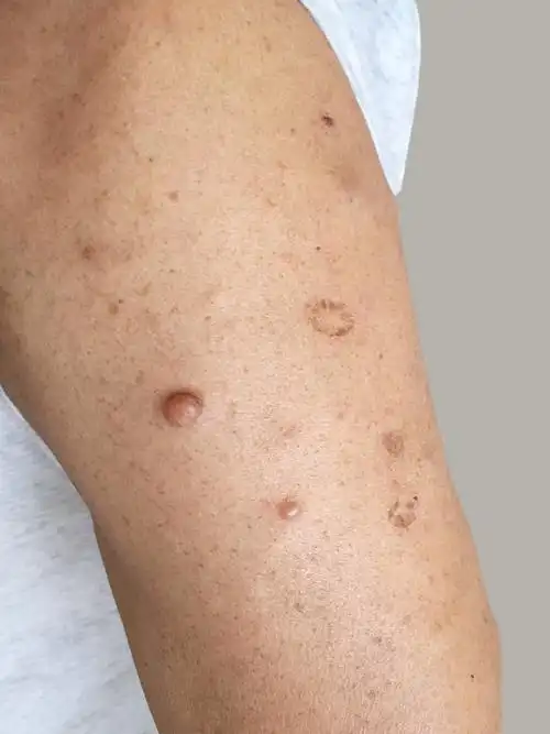 出现皮肤纤维瘤无需担忧手术切除效果好