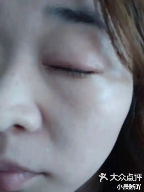 2 打开app查看高清大图 小晨晰吖 3月28日 9:28 关注 眼皮过敏用这个