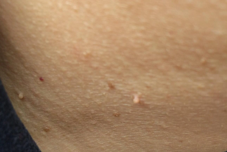 脖子和腋下的"小肉粒"是什么?可以用手揪掉吗?不妨了解一下