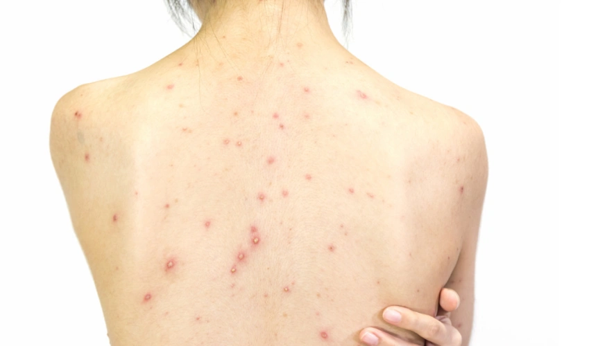 后背痘痘大多数是螨虫在作怪,背部有了螨虫之后,皮肤也会一点点变坏