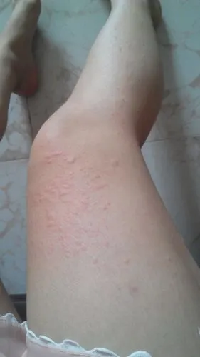 突然全身长包包,很痒