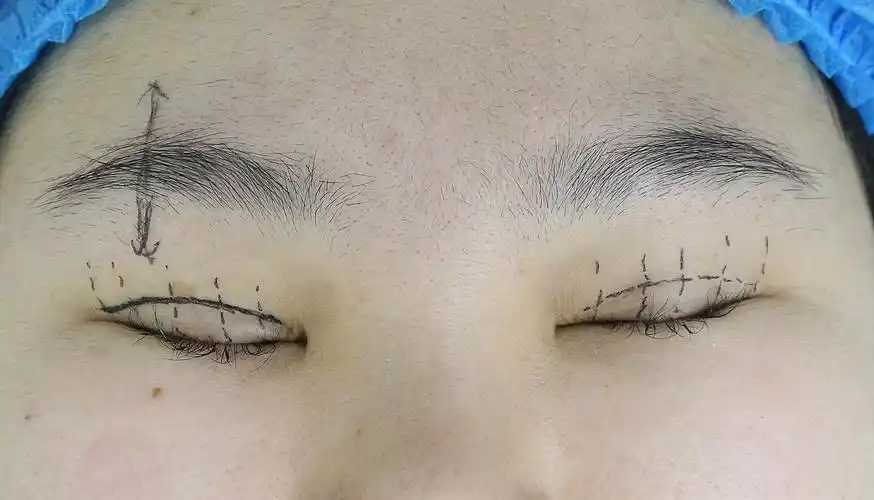 眼皮下垂手术费用多少钱(12月13日单侧上睑下垂修复) - 价格百科