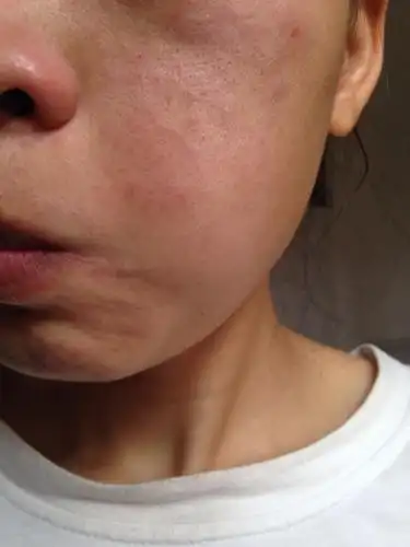 这样的皮肤毛孔堵塞怎么办