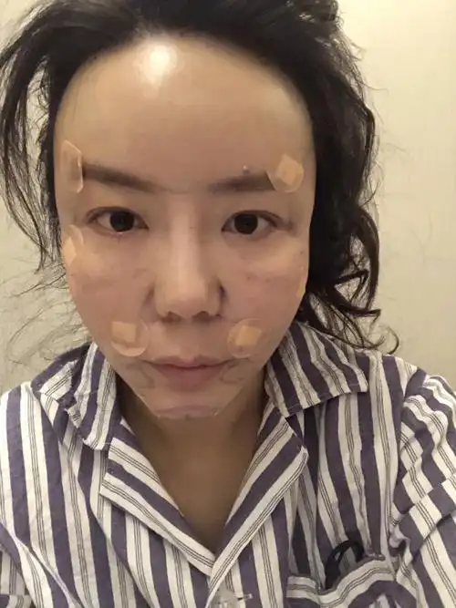 【青岛华颜美-自体脂肪填充面部术后第16天】