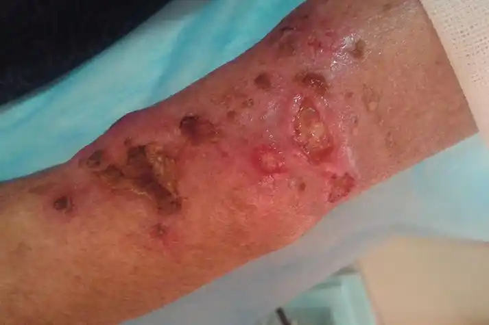 艾滋病初期皮疹症状图片_有来医生