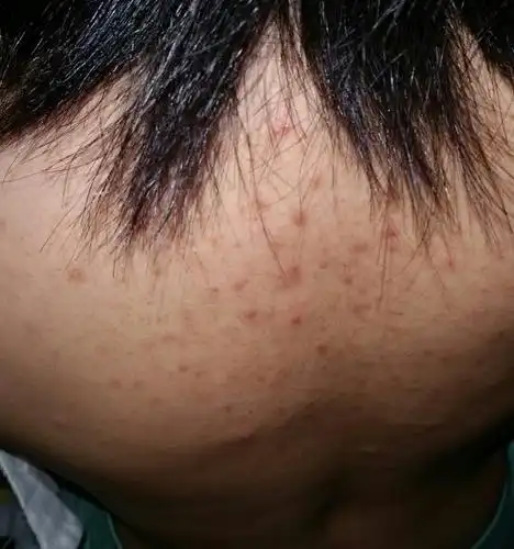 背上好多坨,像粉刺一样