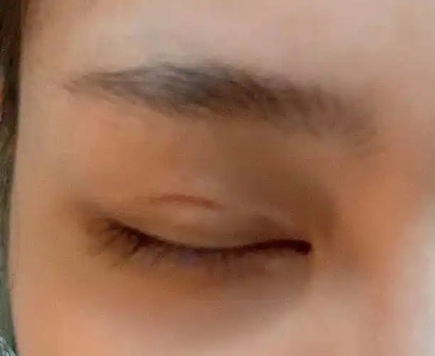 单侧提肌双眼皮快5个月了我是不是割失败了01