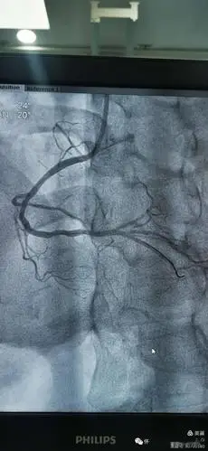 【特别关注】怀仁市人民医院介入导管室完成冠脉造影11例,支架植入2例