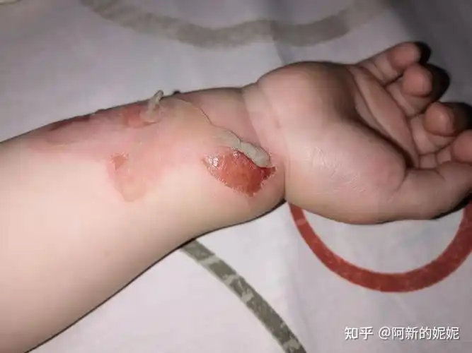 宝宝烫伤记录