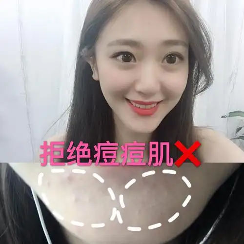 和痘痘说拜拜0569♀1574 本人是资深痘痘肌患者,从初中就开始