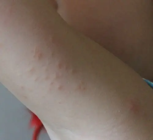 5岁小孩7月2日打完乙肝疫苗几天后腋下和手臂下发长红点会痒,但没发热