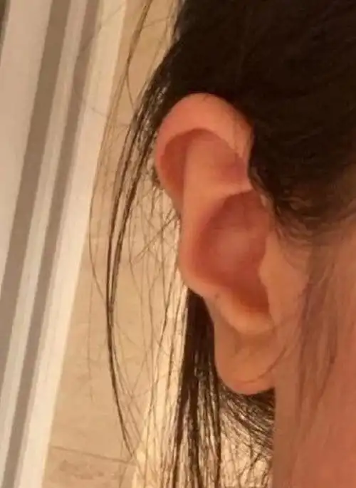 耳相耳骨反耳朵有缺口耳垂有横纹有什么说法