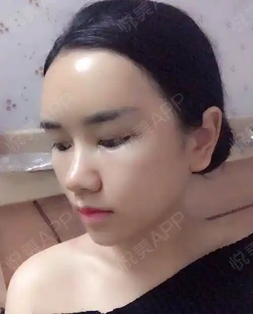 自体脂肪面部填充术后3天_面部填充术后3天_自体脂肪术后3天_面部轮廓