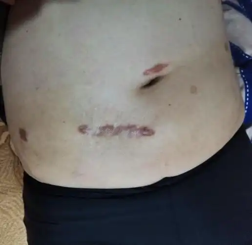 造口还纳,我们同样可以做到"微创中的微创"_直肠癌_直肠癌治疗方式