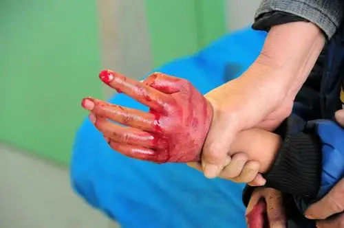 一顽童玩斧头把手剁伤 鲜血淋淋