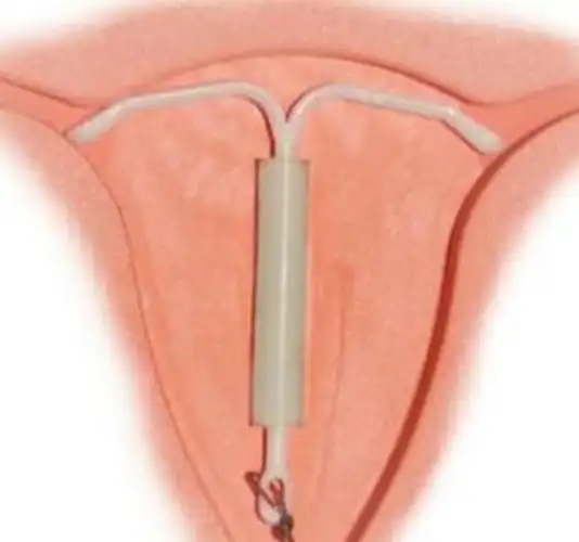 但是不知道上环对自己的伤害有多大|上环|避孕|女性_新浪新闻