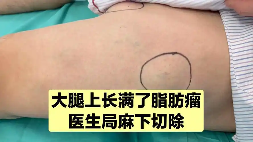 大腿上长满了包子大的脂肪瘤太典型的病例医生忍不住拍照教学