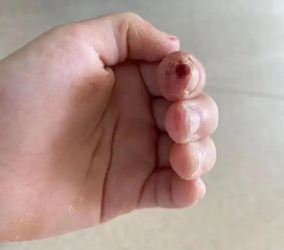 指甲啃得光秃秃,9岁女孩长期咬手引发感染致骨髓炎