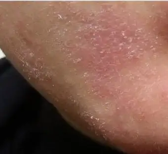 2013-01-07 13:57未知时光|     分类:皮肤科 按默认排序|按时间排序