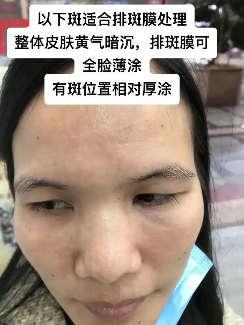 以下斑适合排斑膜处理 整体皮肤黄气暗沉,排斑膜可 有斑位置相 - 抖音