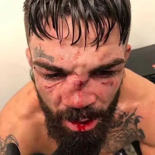 太残暴ufc拳手鼻子被殴打成麻花血液四处喷溅