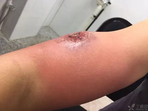 右臂红肿痛溃烂化脓4天 [病例帖]