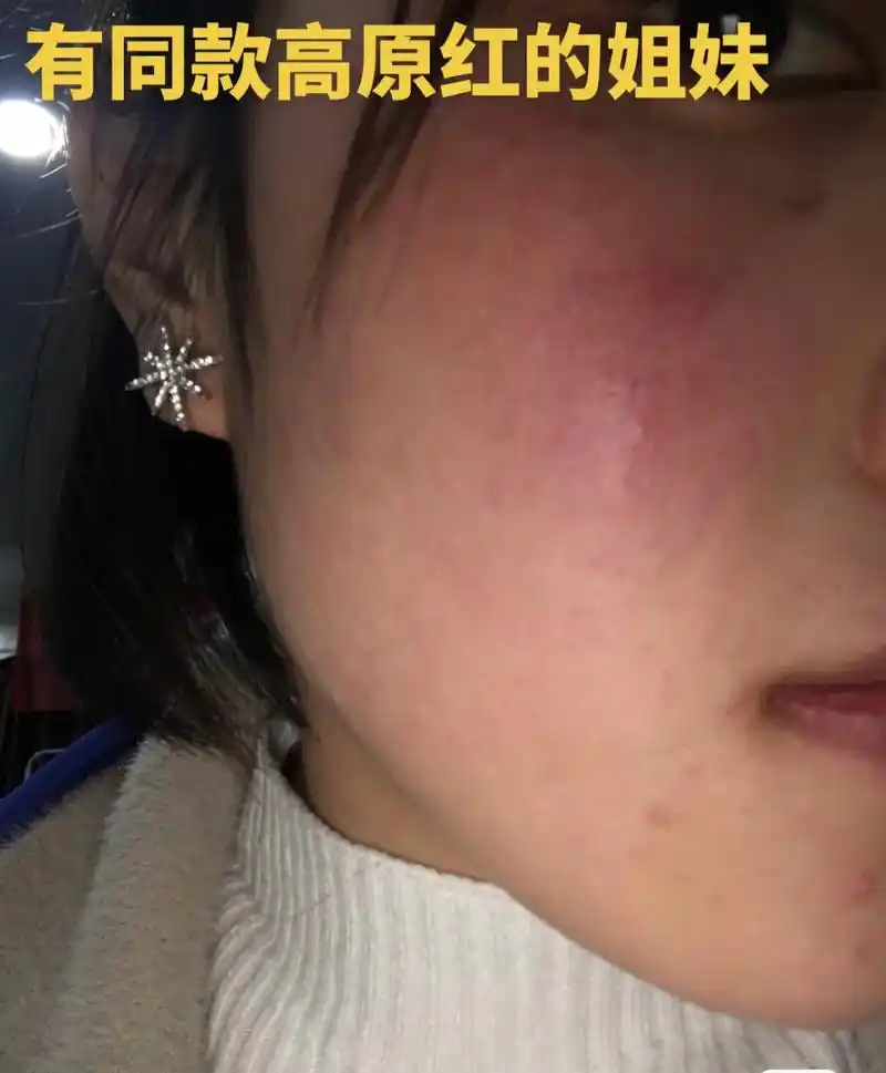 红丝丝#敏感肌 #护肤#红血丝 #修 - 抖音