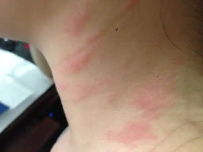 日光性皮炎 到底该怎么治疗!高分寻高人解答!