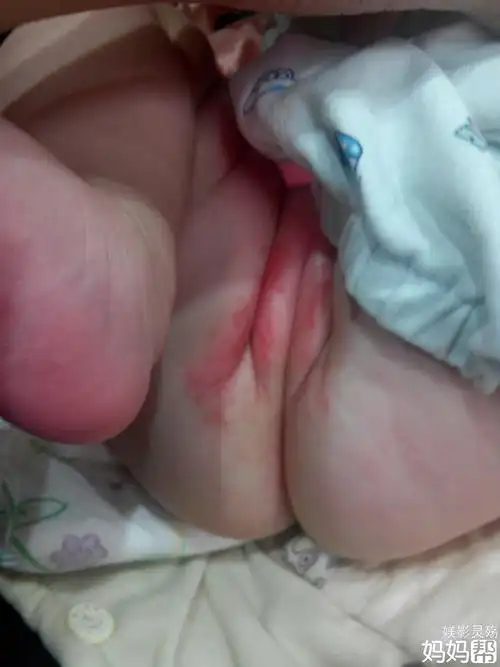 宝宝屁股起湿疹怎么办_宝宝屁股湿疹破皮_宝宝屁股起湿疹怎么办