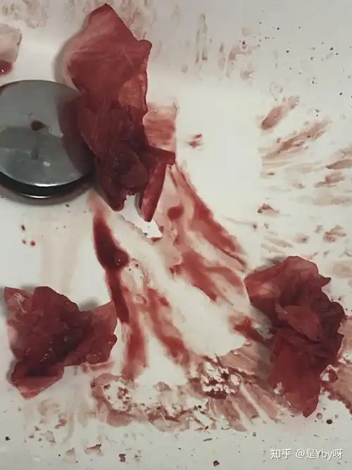 必看鼻中隔偏曲手术全过程猛流血教训