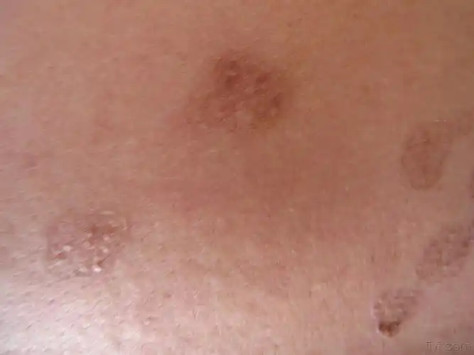 遗传性皮肤病请大家诊治 - 皮肤及性传播疾病讨论版 - 爱爱医医学论坛