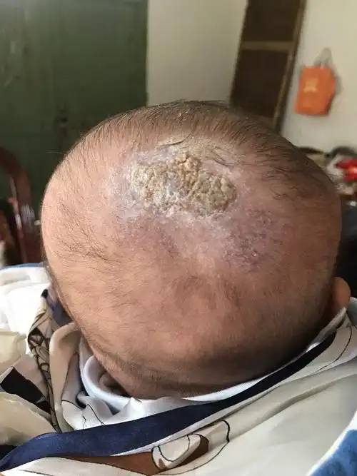 我家宝宝五个月大两三周以来后脑一直有的发红有时候有黄色的