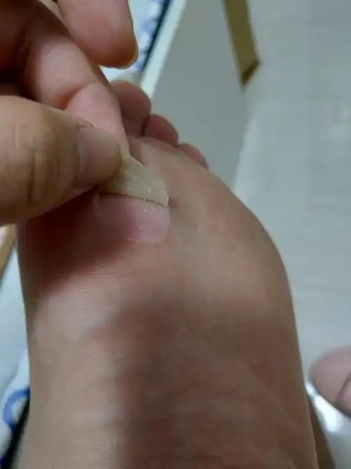 我与脚上的水泡06