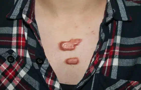 病况:前胸部因毛囊炎导致的瘢痕疙瘩,虽然发病5年了,是不是还会痒痛