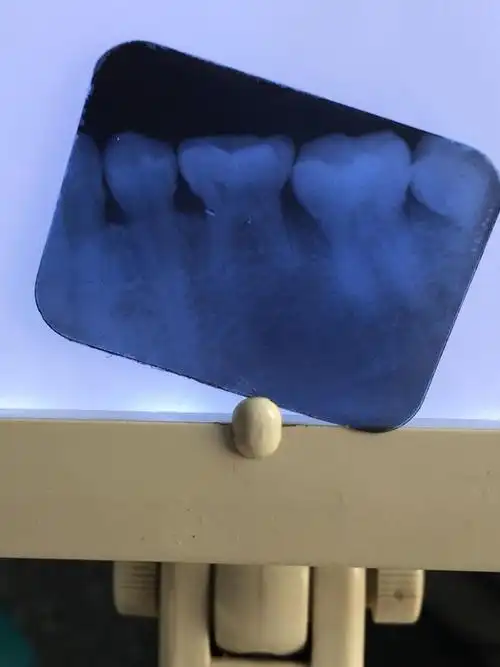 先天性下合第二双尖牙缺失