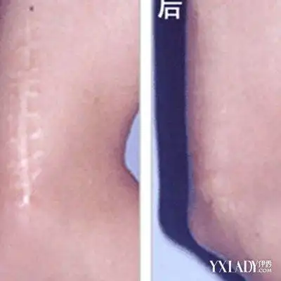 手术后疤痕照片图片展示 两大误区需谨记