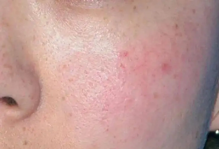 一到春天就烂脸过敏如何拯救